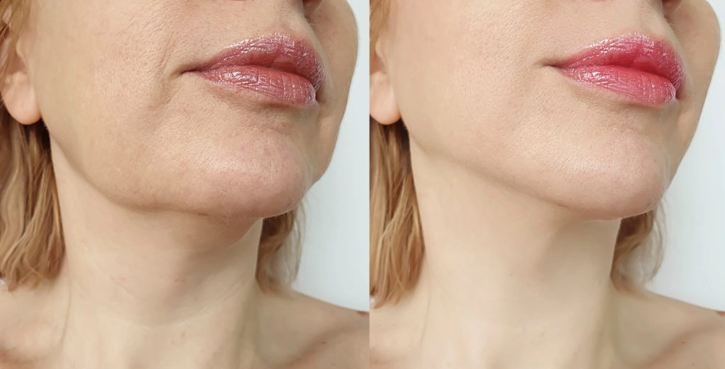 Resultados del tratamiento facial con ácido hialurónico